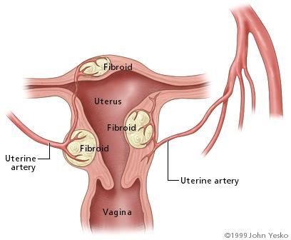 fibroid tumor